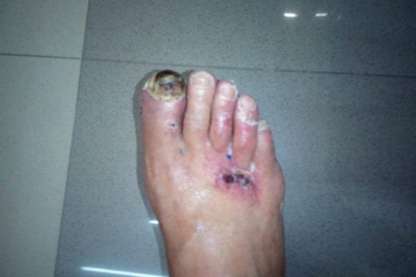 diabetic-foot-1