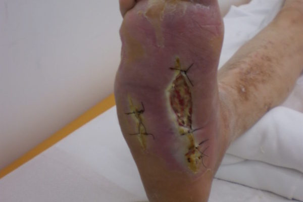 diabetic-foot-2