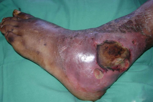 diabetic-foot-3