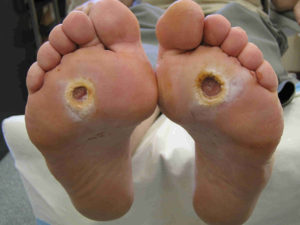 Diabetic foot - Cuba Medic - Treatment of all types of cancer, diabetic