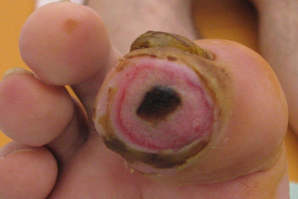 diabetic-foot-4